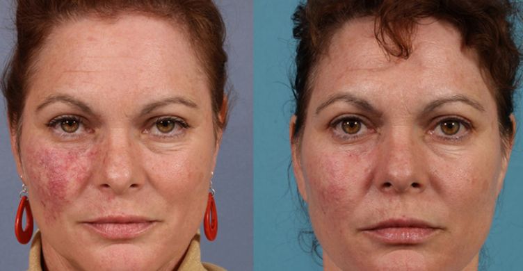Before &After